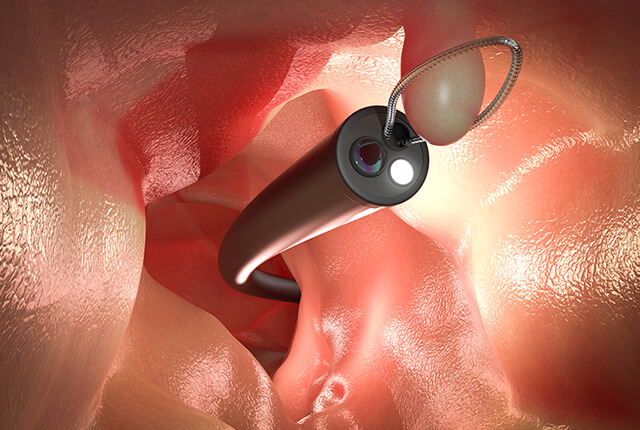 大腸ポリープ切除手術のイメージ