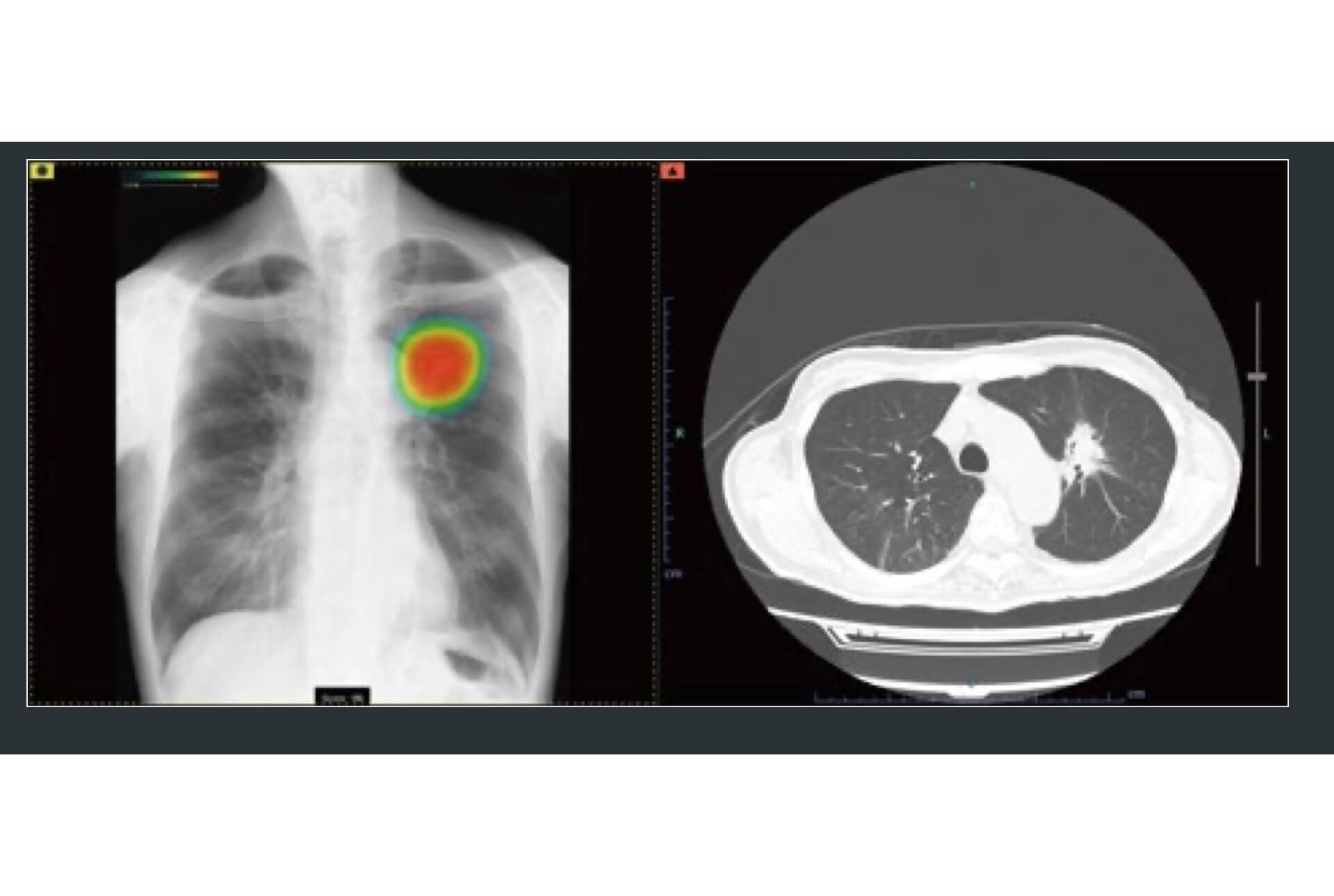 胸部レントゲンAI診断システム「CXR-AID」